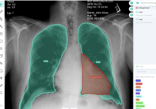 AI-Assisted Chest X-Ray Analysis