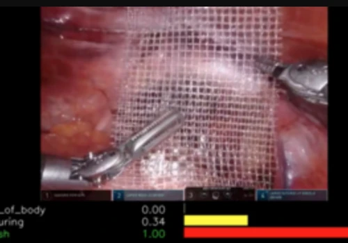 AI Backed Surgery