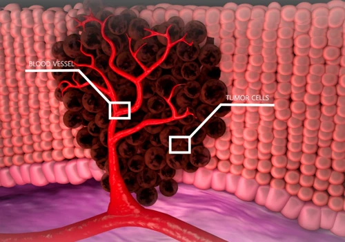 Tumor cells