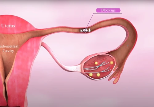 Blocked Fallopian Tubes