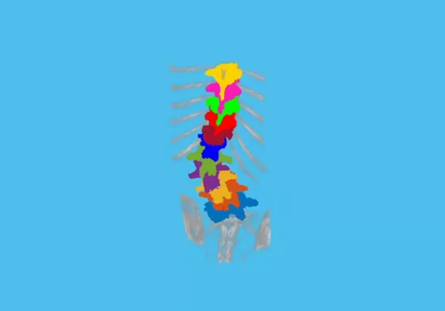 Augmented Reality Guidance for Spine Surgery