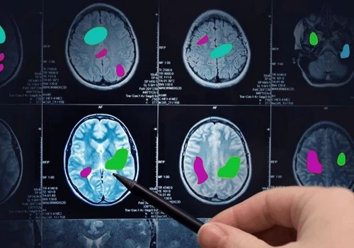 AI in Healthcare for Diagnostic