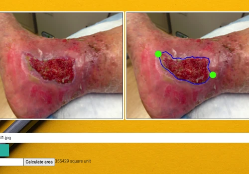Wound Identification and Area Measurement computer vision AI/ML based work.